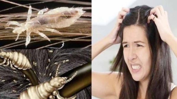 মাথার উকুন দূর করার উপায়